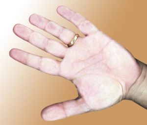 A hand with white spots on it and a ring in the middle of its finger.